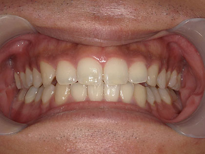 オフィスホワイトニングの術前1