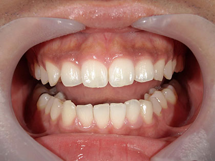 セラミック治療、ダイレクトボンディングを行った症例の画像