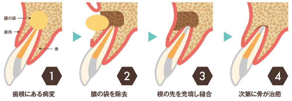歯根端切除 歯を残す為の治療