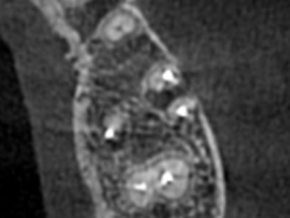 歯根端切除の術前1
