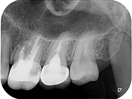 歯根端切除の術後10