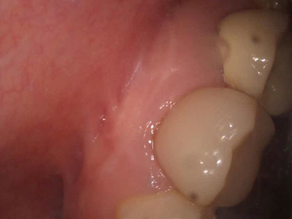 歯根端切除の術後12