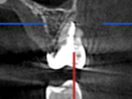 歯根端切除の術前2