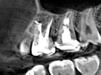 歯根端切除の術前3