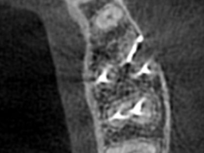 歯根端切除の術後6