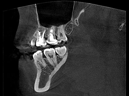 歯根端切除の術後9