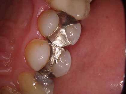 emaxインレーの術前1