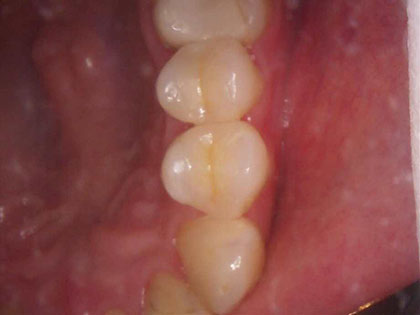 セラミック治療、emaxインレーを行った症例の画像