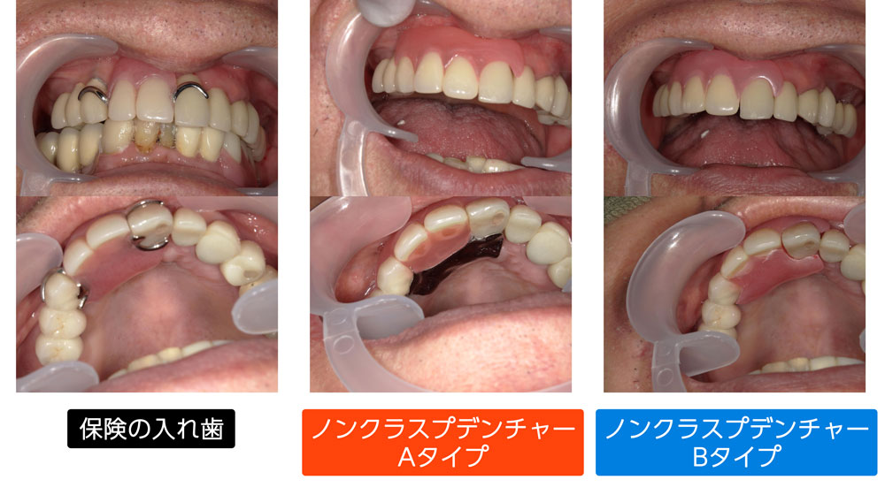 保険入れ歯とノンクラスプデンチャー