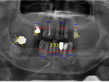 義歯（入れ歯）術前1