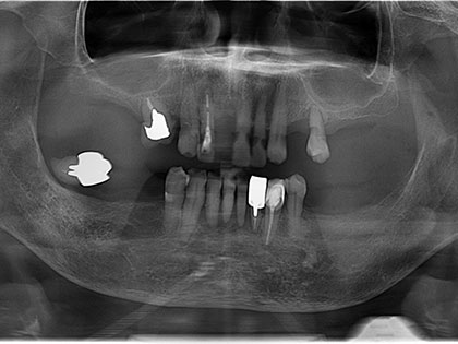 義歯（入れ歯）術前2