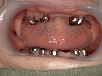 義歯（入れ歯）治療中1