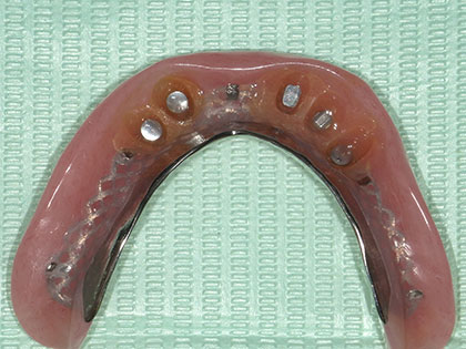 義歯（入れ歯）治療中2