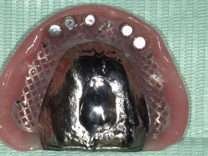 義歯（入れ歯）治療完了時1