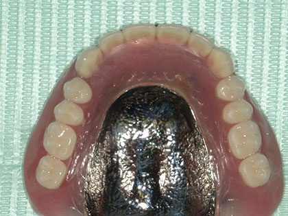 義歯（入れ歯）治療完了時2