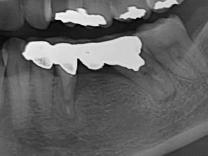 インプラント術前1
