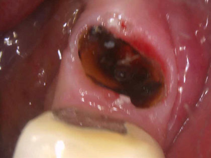 インプラント治療中1