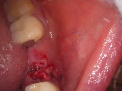 インプラント治療中2