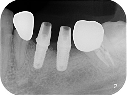 左下5が定期的に腫れるためインプラント治療を行った症例の画像