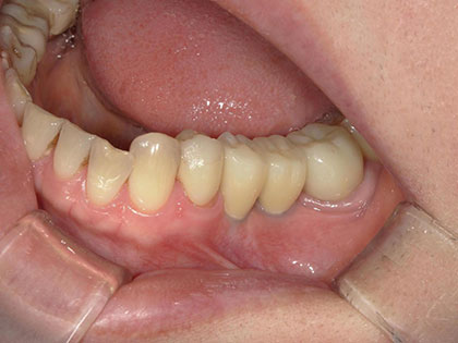 インプラント治療完了時1