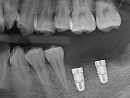 インプラント治療中1