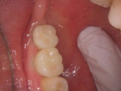 左下6が噛むと痛く、7に歯をいれたいためインプラントを希望インプラント治療を行った症例の画像