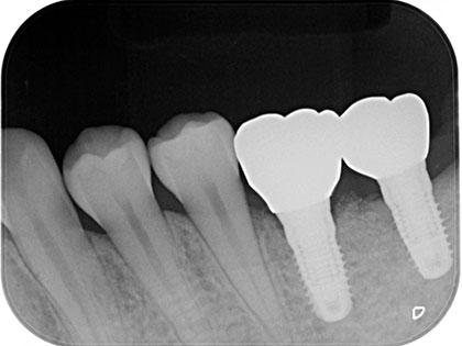 インプラント治療完了時2