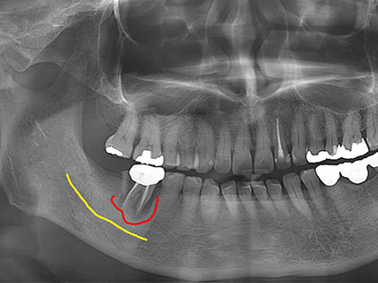 インプラント術前1