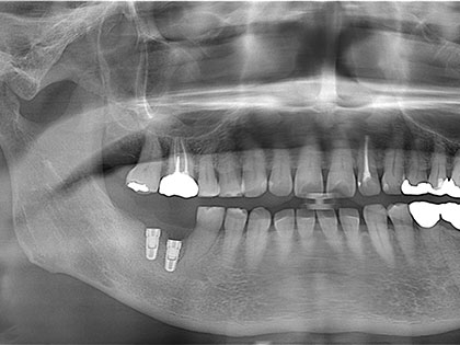 インプラント治療完了時1