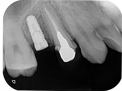 インプラント治療中1