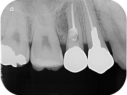 右上5番目にインプラント治療を行った症例の画像