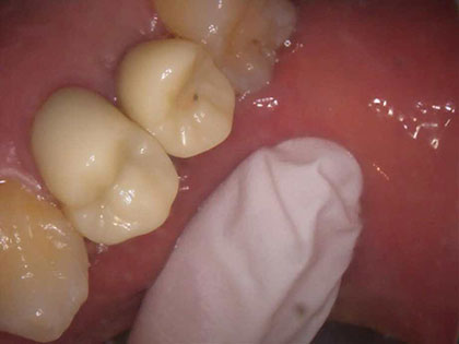 インプラント治療完了時2