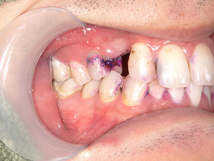 インプラント術前1