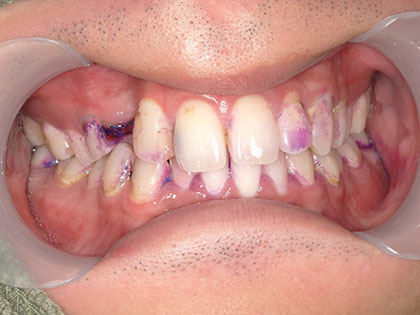 インプラント術前2