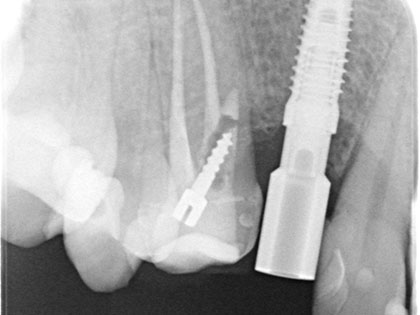 右上3番目にインプラント治療を行った症例の画像