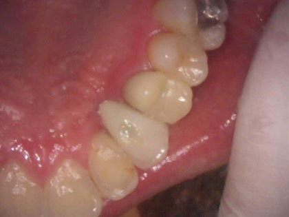 インプラント治療中2