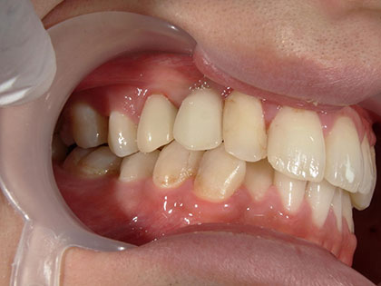 インプラント治療完了時1