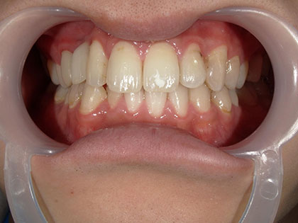 インプラント治療完了時2