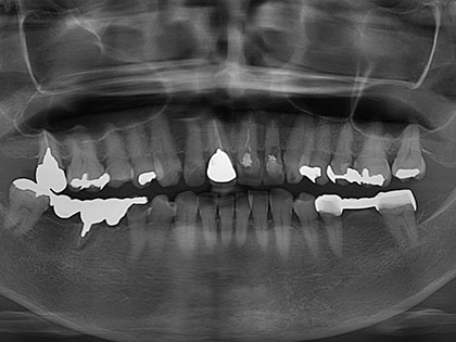 インプラント術前1