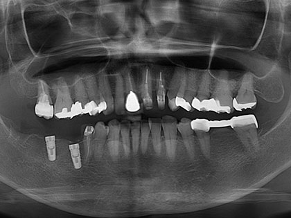 インプラント治療中1