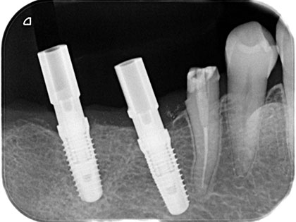 左下6番目、7番目にインプラント治療を行った症例の画像