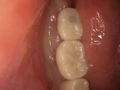 インプラント治療完了時1