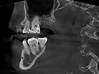 インプラント術前1