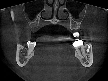インプラント術前2