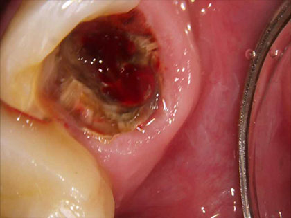 インプラント術前2