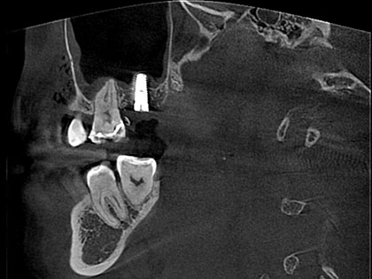 右上被せ物がとれたためインプラント治療を行った症例の画像