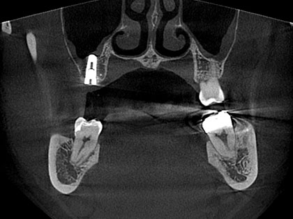 インプラント治療中2