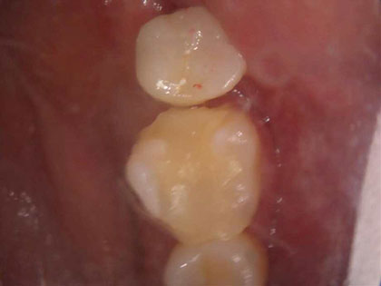 インプラント治療完了時1