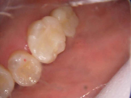 インプラント治療完了時2