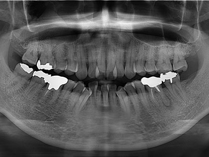 インプラント術前2